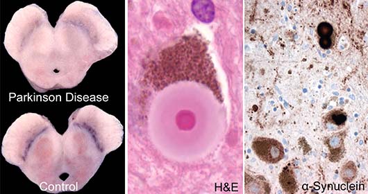 Parkinson’s disease (left panel), midbrain, showing pallor following marked neuronal loss. Hematoxylin and eosin (H&E) stained section showing a Lewy body (middle panel). Immunohistochemistry to alpha-synuclein reveals inclusions (right panel).